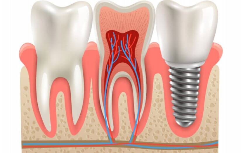 Dental implants Types and comparison Grand Central Dentistry