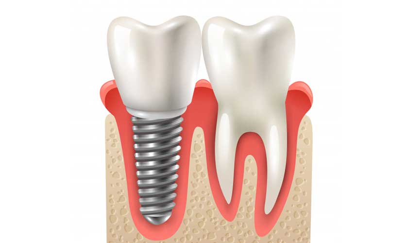 dental-implants