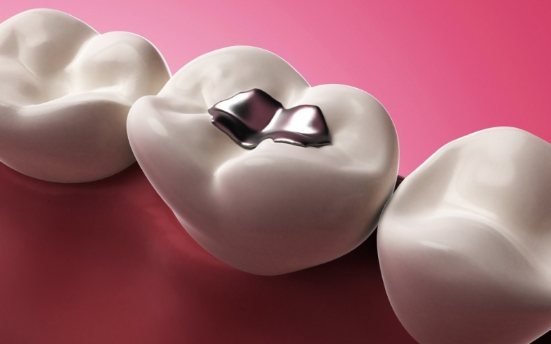 Durability of Composite Fillings