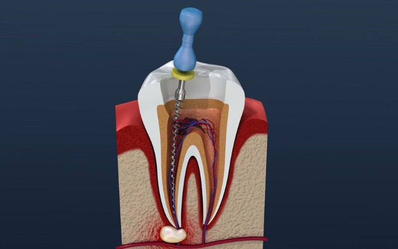 Unusual Symptoms for Root Canal Treatment