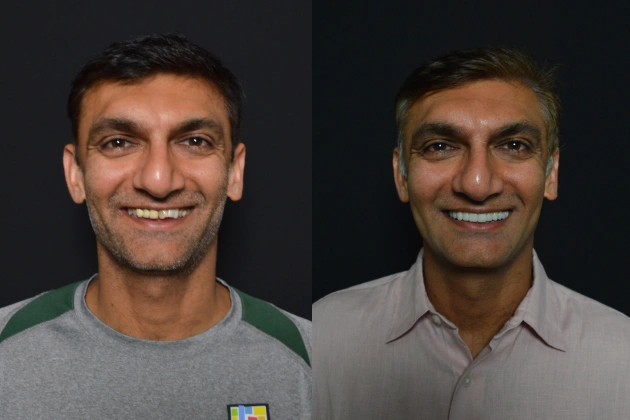 Kashyaps Smiles